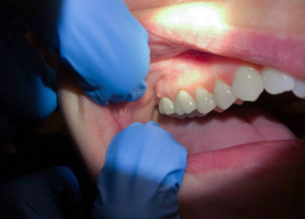 Best Emergency Dentist for Lost Fillings or Crowns in Edmore, MI